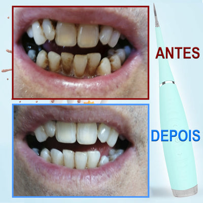 Limpador dental Ultrassônico